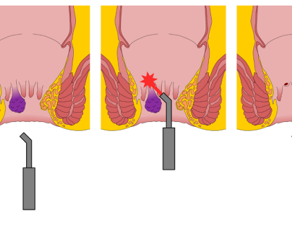 Điều trị bệnh trĩ bằng phương pháp laser